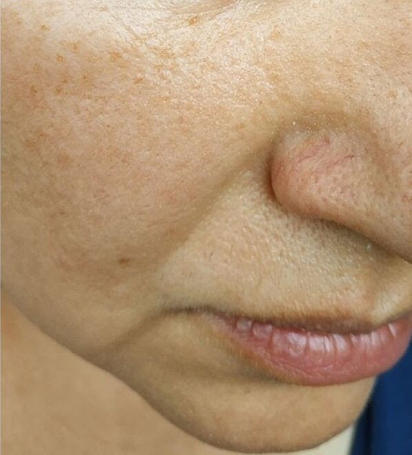 At the age of 40, the fold of the nose appears