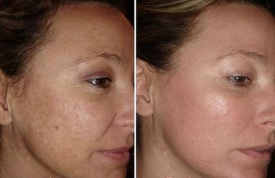 Laser face skin rejuvenation before and after pictures